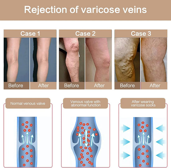 Calze Compressiva Donna 20-30 mmHg Graduata – Supporto Circolazione e Varici